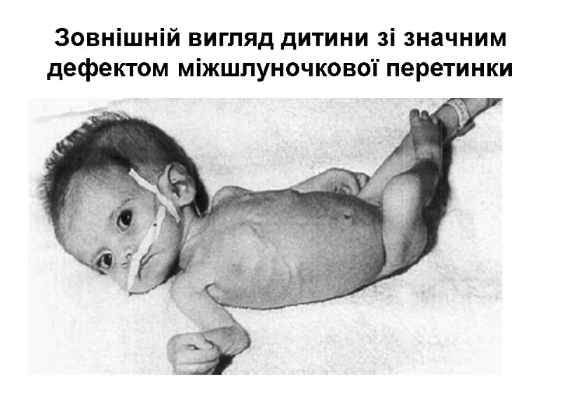 Зовнішній вигляд дитини зі значним дефектом міжшлуночкової перетинки